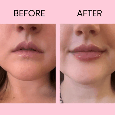 HELLIORA™ – LipLift Boost